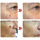 Remova Verrugas, manchas e marcas - VerruClean™  COMPRE 1 LEVE 2